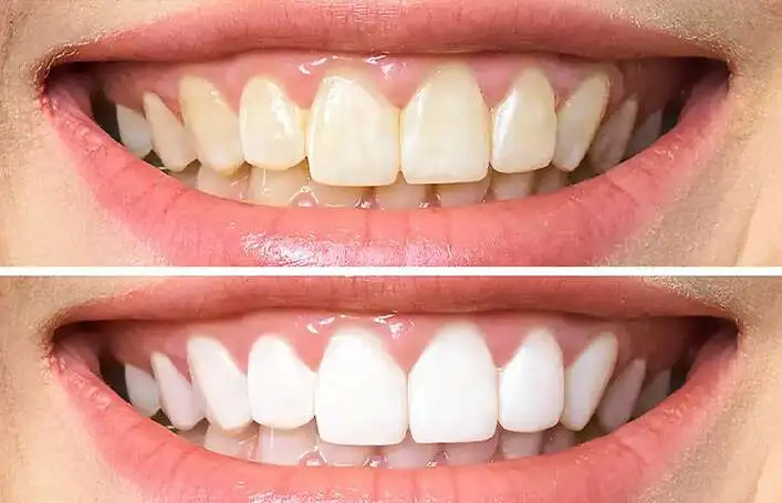 Best country for teeth whitening treatment