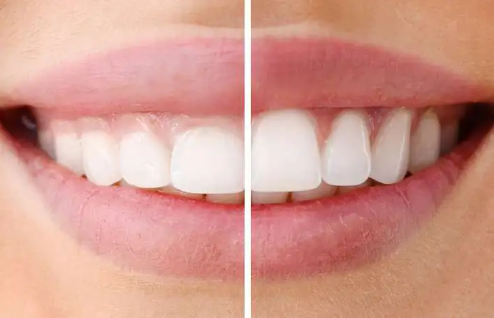 Best gum correction surgery in Albania