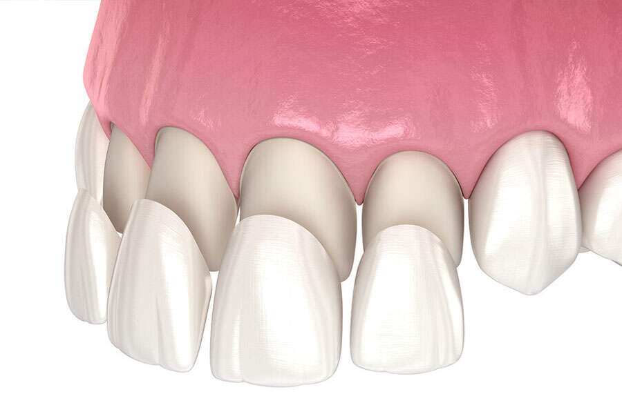 Dental Veneers in Albania