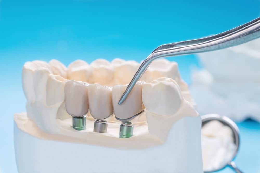 Zirconia Crowns in Albania