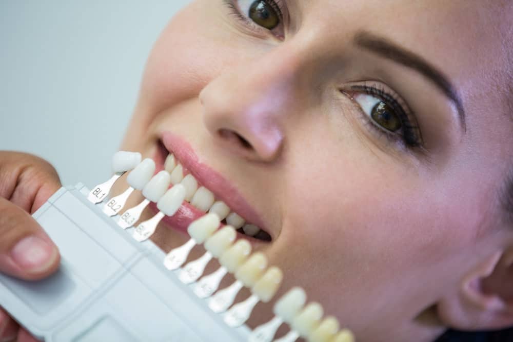 Professional Teeth Whitening in Albania