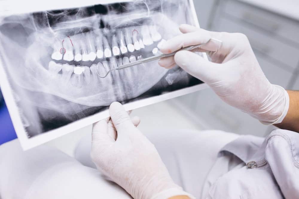 Best all on 4 dental implants in Albania