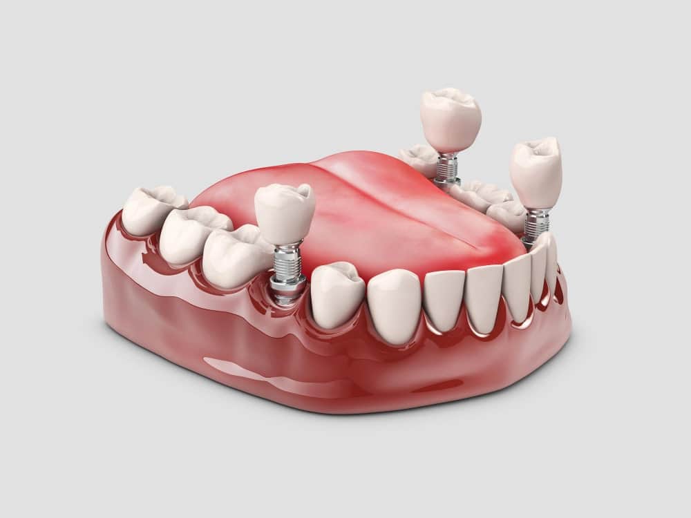 The best dental implants in Albania