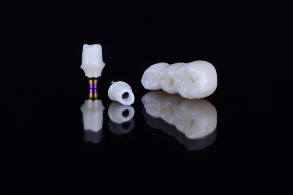 Image illustrating zirconia crowns in Albania to restore missing teeth