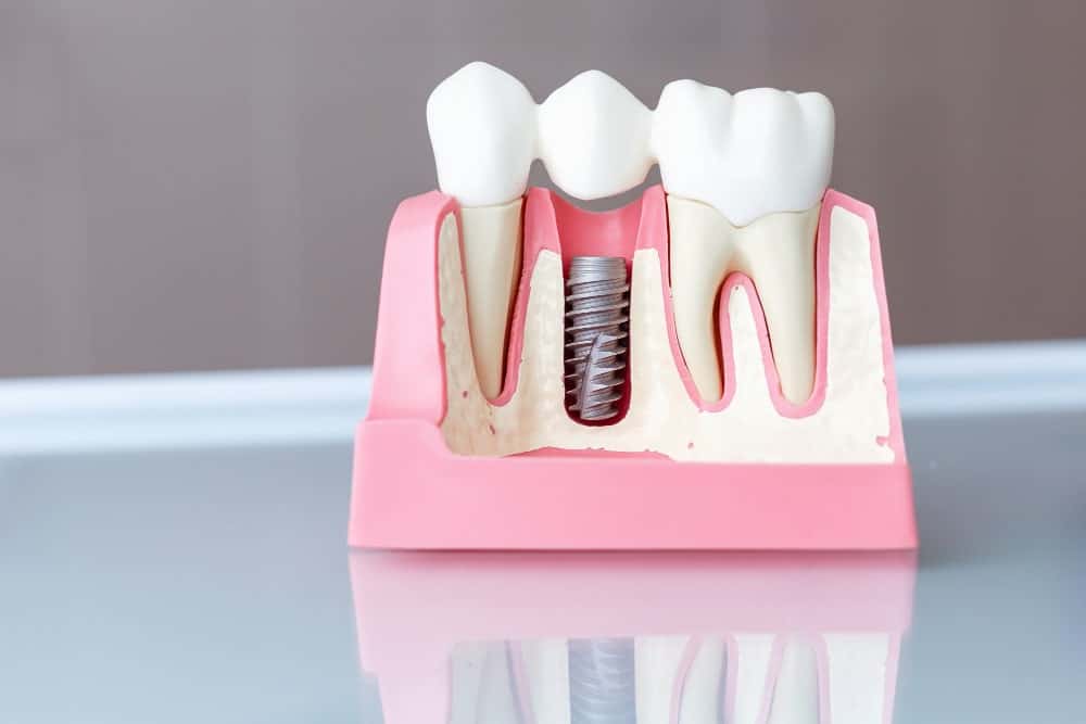 Image illustrating dental implant types