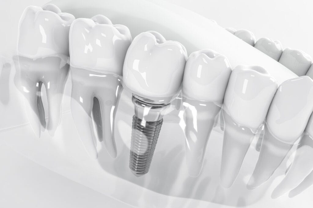 Image illustrating dental implant treatment in Albania
