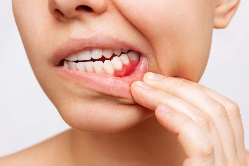 Patient with periodontal disease.