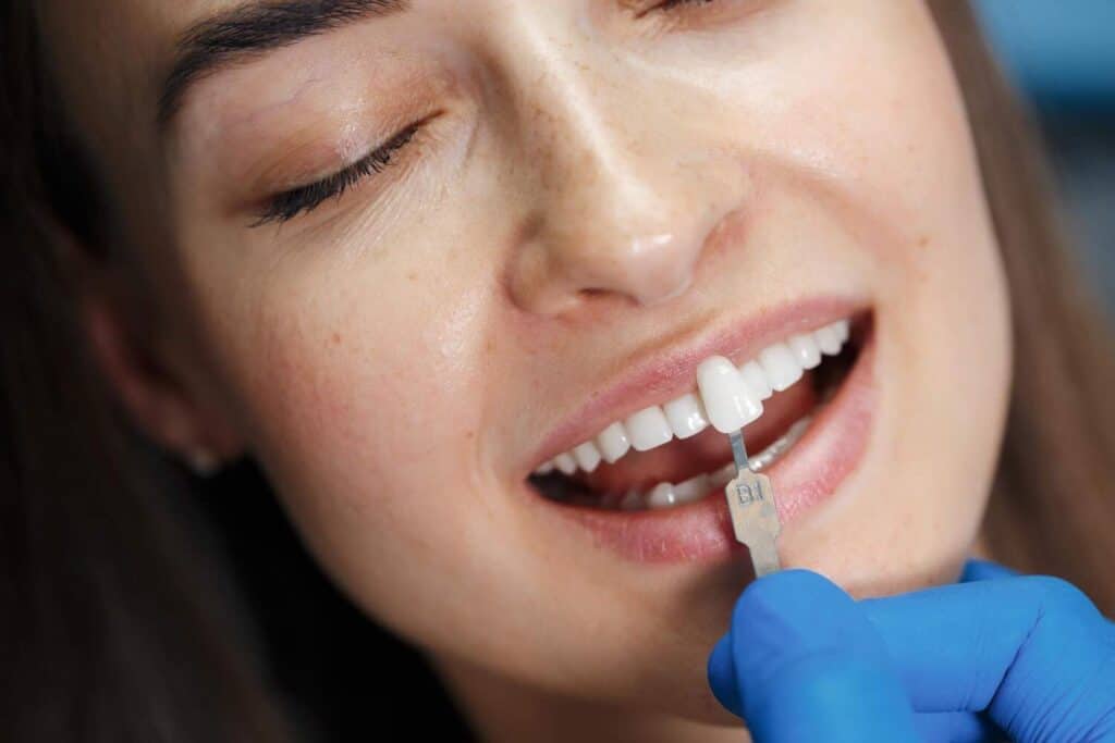 Image illustrating dental veneers in Albania.