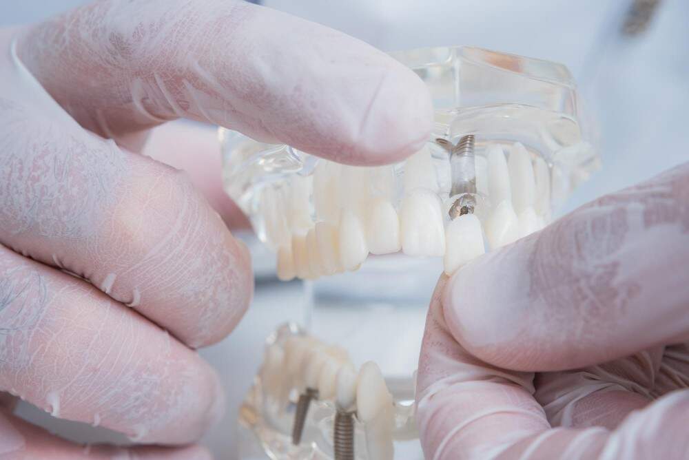 Image illustrating dental implant structure.