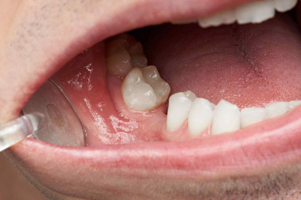 Immagine che illustra un paziente con un dente perso