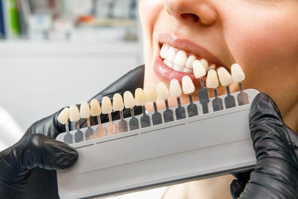 Immagine che illustra le faccette dentali sicure e convenienti in Albania