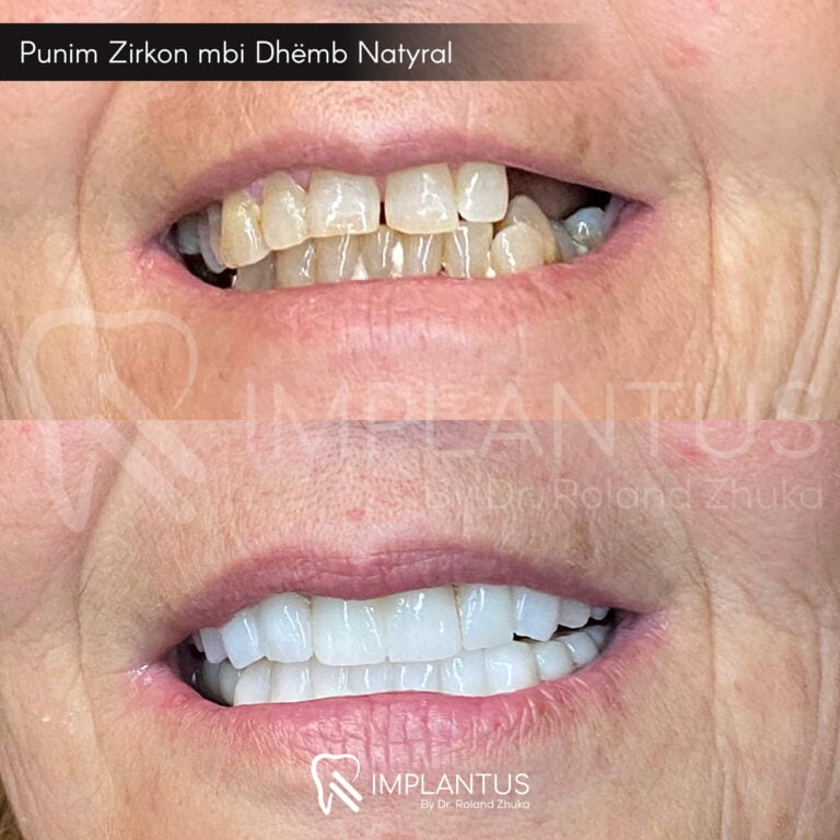 Prima e dopo i dentisti in Albania