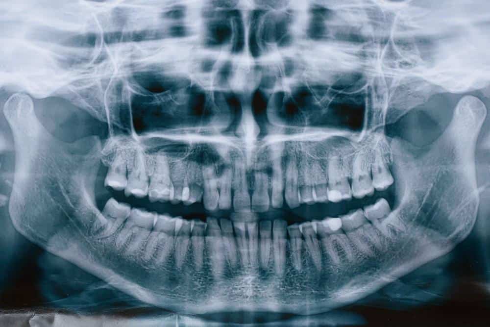 innesto osseo in Albania per i pazienti con perdita di osso dentale