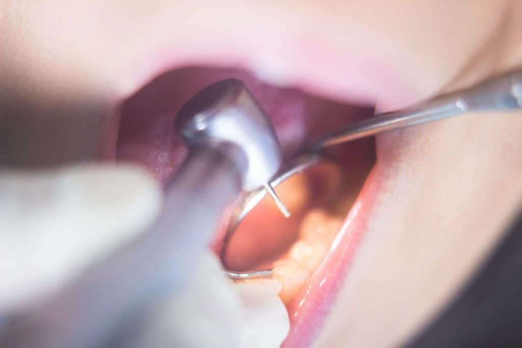 Otturazioni dentali bianche