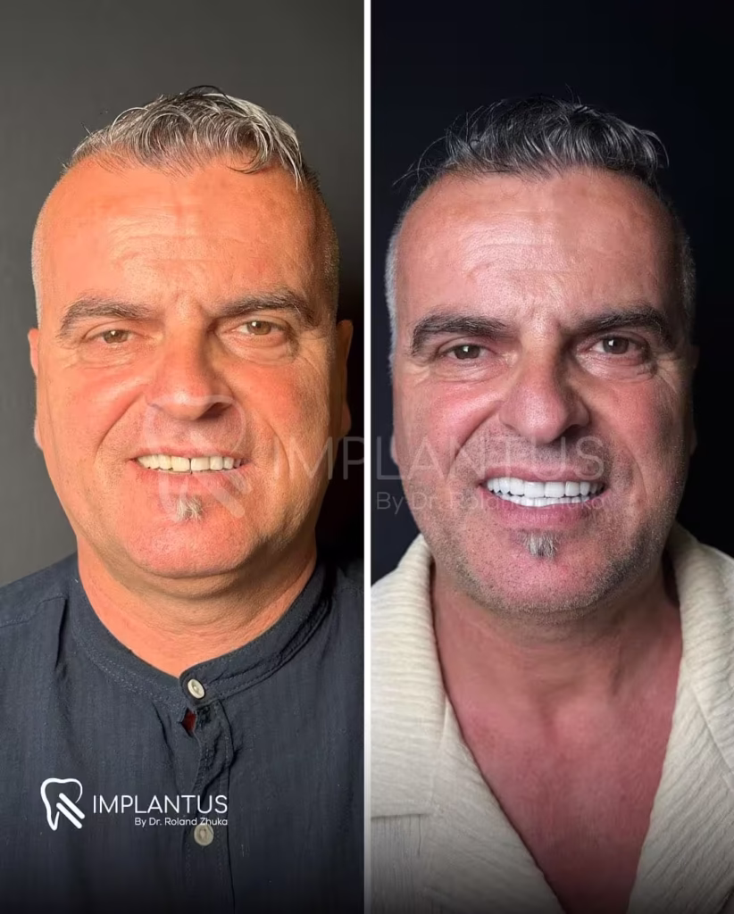 Beard Area Smile Improvement With Dental Implants – Male Patient Albania Dentist_converted