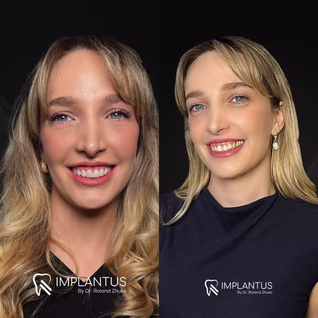 Cosmetic Dental Alignment Result – Balanced Smile Design in Albania_converted