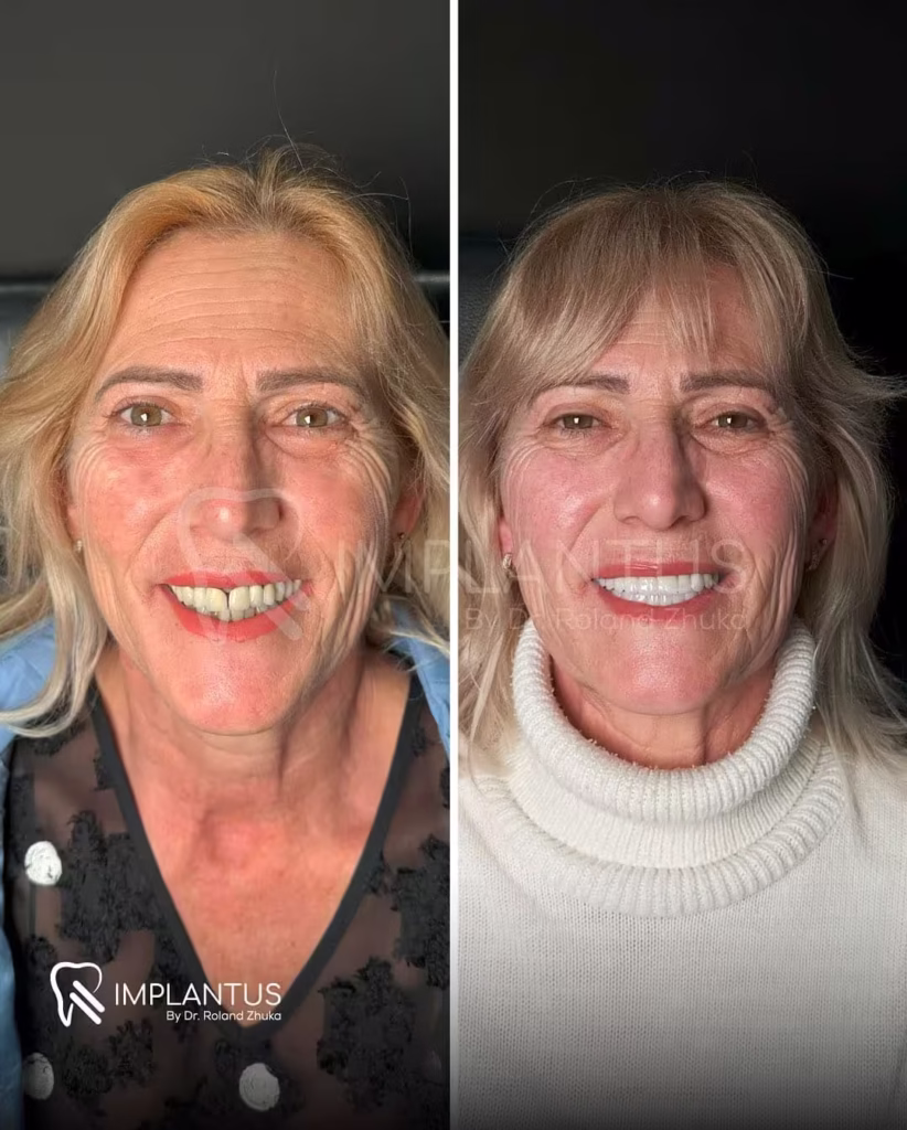 Cosmetic Dental Implant Result – Female Patient Dr. Roland Zhuka_converted