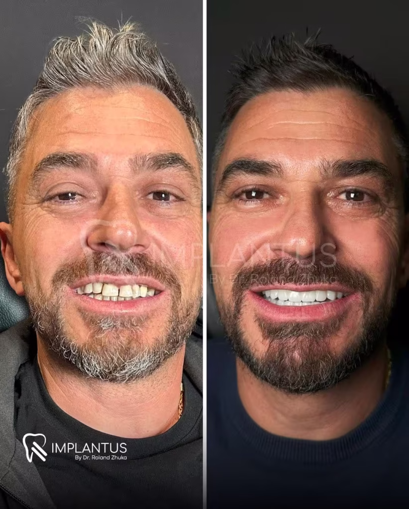 Dental Implant Smile Makeover – Male Patient Before and After Albania_converted