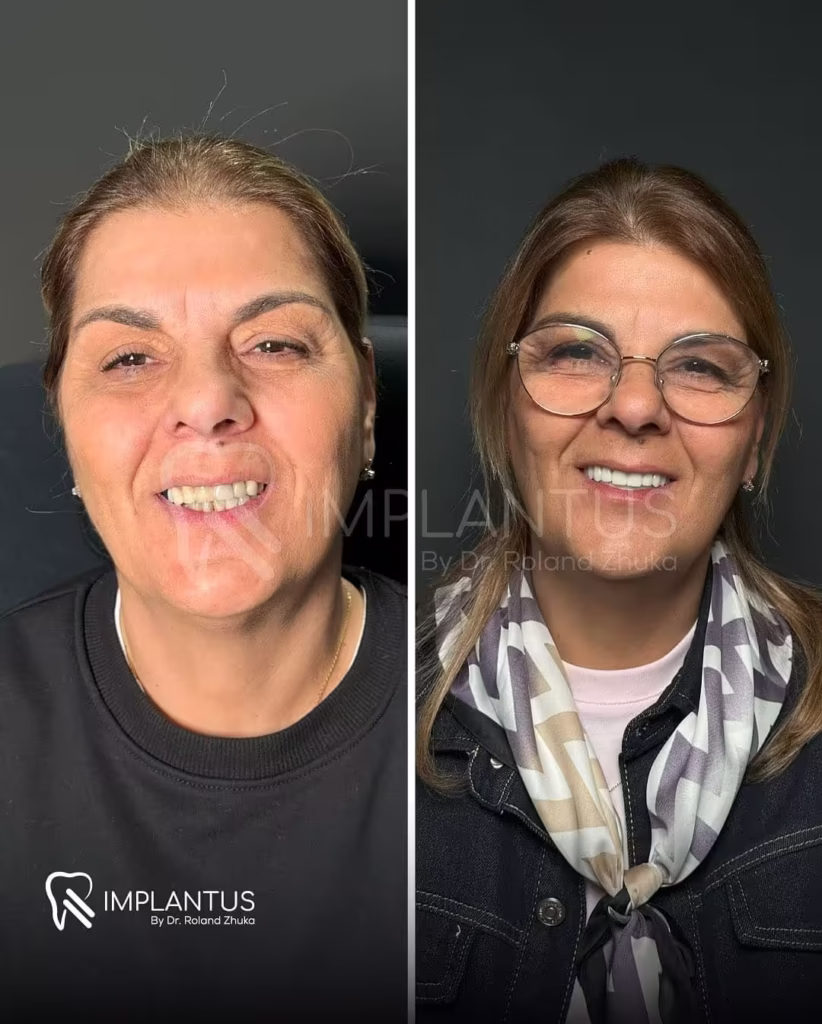 Dental Implant Smile Restoration – Female Patient Before and After Albania_converted