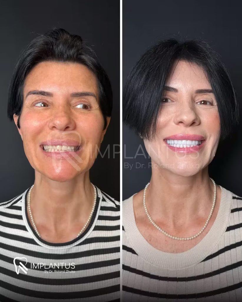 Smile Transformation With Dental Implants – Female Patient Albania Dentist_converted