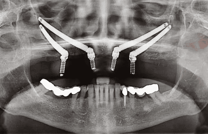 Panoramic dental X-ray showing angled upper jaw implants and lower molar restorations