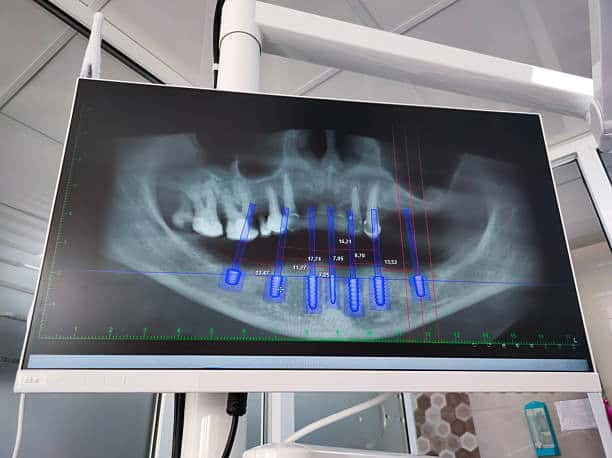 Panoramic dental X-ray on monitor with implant planning measurement overlays.