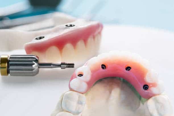 Dental driver positioning screw for implant-supported upper denture on dental implants