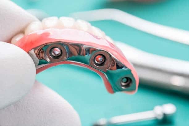 Underside of implant-supported denture showing three abutment screw holes