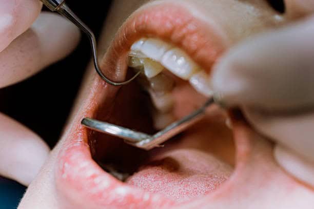 Dental exam using mirror and probe to inspect back teeth