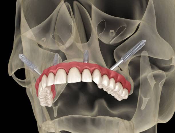 Zygomatic dental implants anchoring an upper full-arch denture in the upper jaw