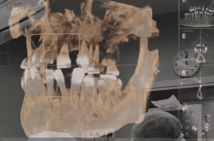 3D dental X-ray showing jaw structure and selected teeth for assessment