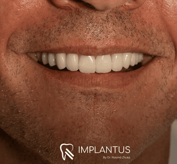 Close-up smile showing upper teeth with dental implant restorations