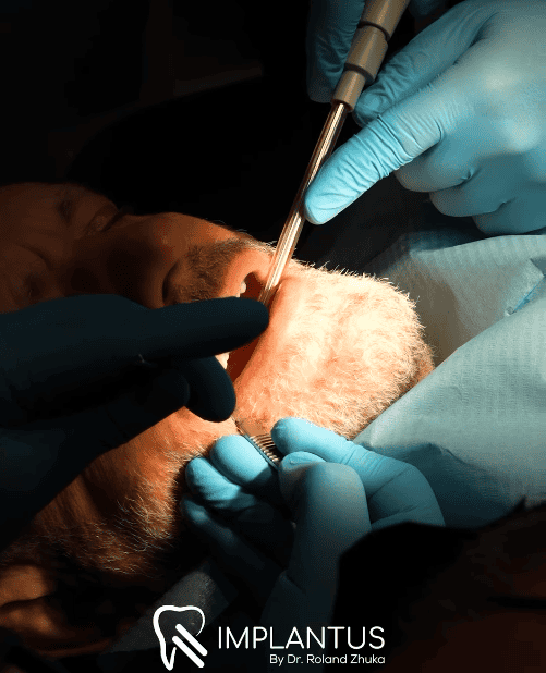 Gloved dental surgeon placing a dental implant in an adult patient's mouth.