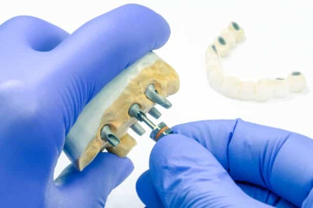 Gloved hands adjust abutments on full-arch dental implant model, prosthetic bridge in background.