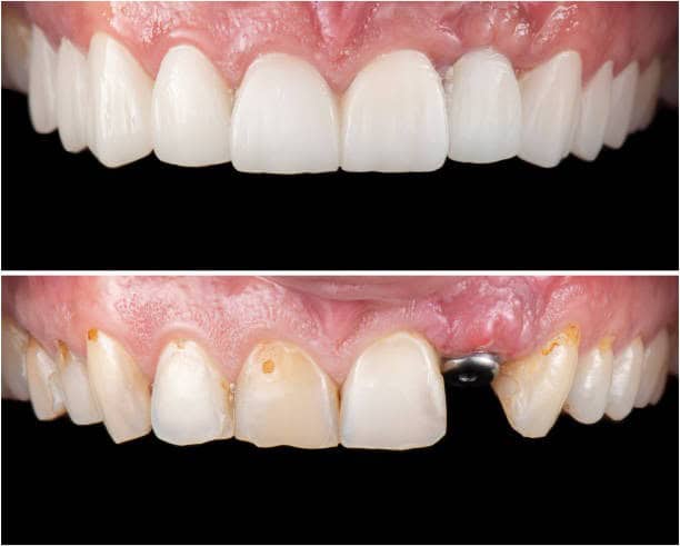 Primo piano dei denti anteriori superiori prima e dopo, moncone di impianto dentale ripristinato con corone in porcellana e faccette.