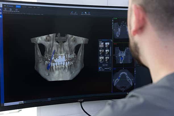 Dentista esamina la scansione CBCT 3D che pianifica l'inserimento di un impianto dentale su un monitor widescreen.