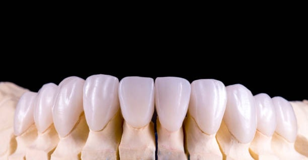 Close-up of ceramic veneers on upper arch plaster model, black background.