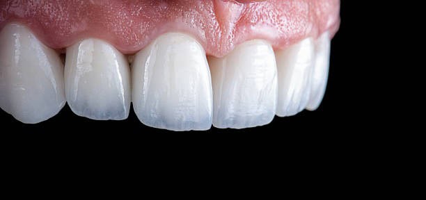 Close-up of upper front teeth with porcelain veneers and healthy gums, black background.