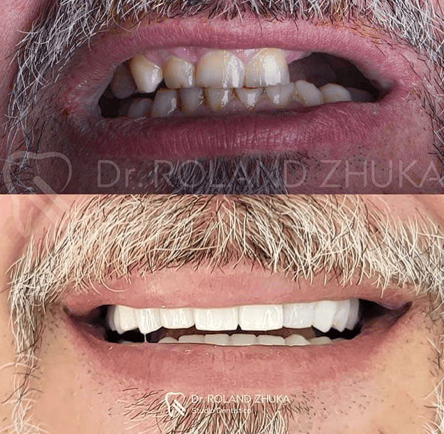Before-and-after smile transformation from missing teeth to uniform white fixed dental restorations.
