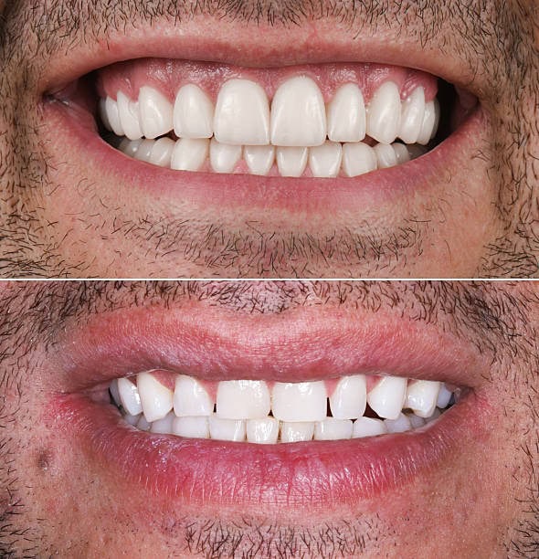 Due primi piani sovrapposti dello stesso sorriso della persona con un diverso allineamento dei denti