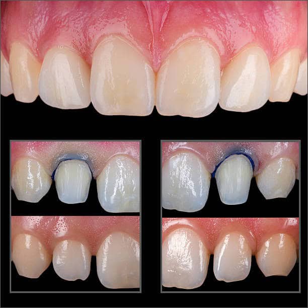 Preparazione e posizionamento della corona dentale sui denti anteriori superiori con filo retrattore gengivale