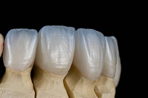 Faccette dentali in ceramica sui denti anteriori superiori mostrati su un modello in gesso