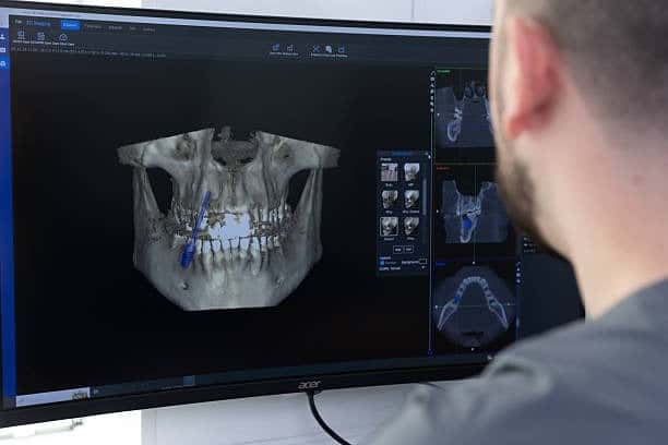 Dentist reviews 3D dental CT scan of jaw in implant planning software