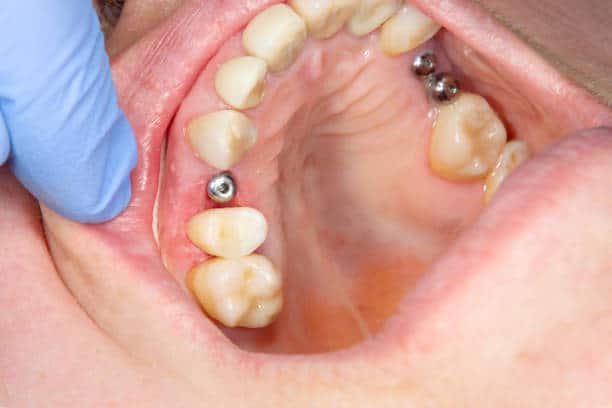 Upper jaw with two dental implant abutments among molars, cheek retracted by gloved hand