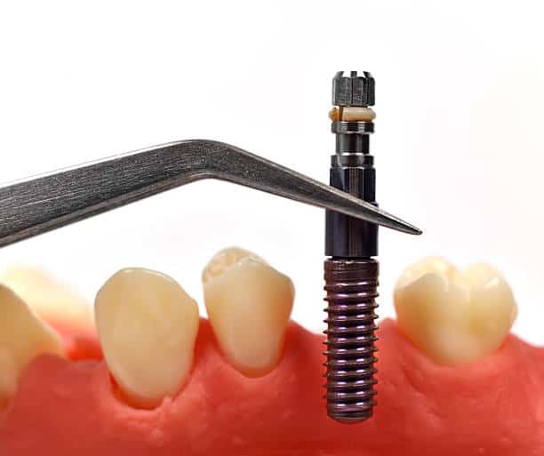Titanium dental implant screw held by forceps over gum model with teeth