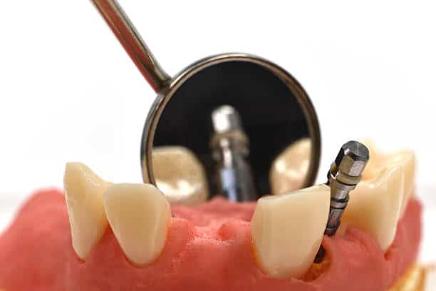 Dental mirror inspecting dental implant abutment on gum model with adjacent teeth