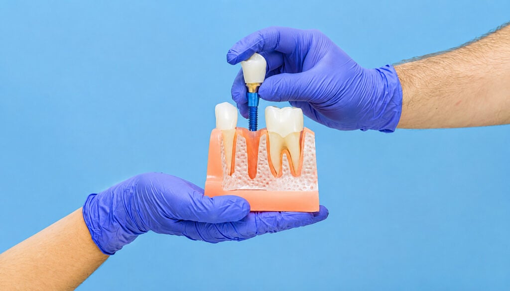 Hands in purple gloves demonstrate dental implant placement on jaw model, blue background.