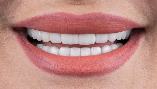 Close-up smile with evenly aligned, bright white teeth and soft coral lipstick.