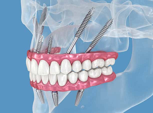 3D illustration of titanium implants anchoring a full-arch bridge within translucent jawbone.