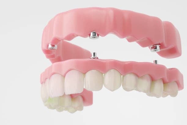 Upper and lower full-arch bridges showing dental implant abutments on a white background.